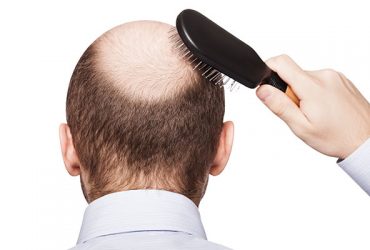 hair loss