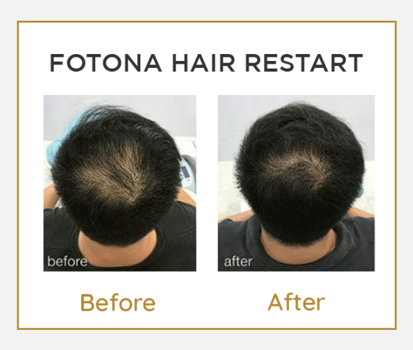 Fotona HAIR RESTART BA 3