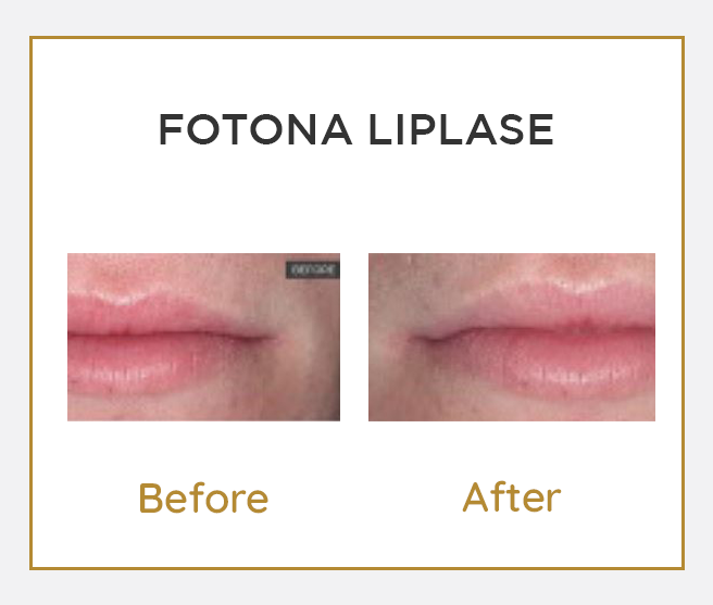 fotona-liplase-karpati-skin-clinic-double-bay-sydney